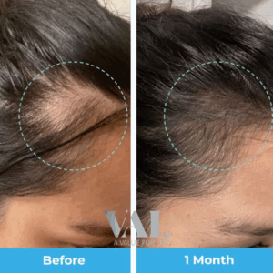 Caffeine – السر في تنشيط البصيلات الخاملة: ينشط الدورة الدموية، يطوّل عمر الشعرة، وبيقلل تأثير الهرمونات اللي بتسبب التساقط الوراثي.